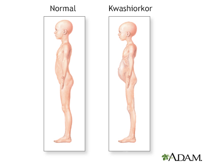 Kwashiorkor symptoms